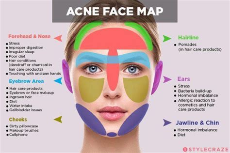 Acne Body Mapping Explained, and How to Deal with Unwanted Body Blemishes