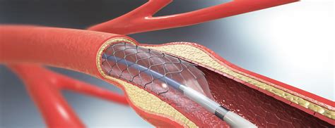 Are Stents Really Necessary - calories, carbs, nutrition