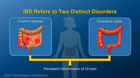 Discover Additional IBD Resources for Better Condition Management