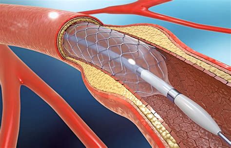 Do Stents Work - calories, carbs, nutrition