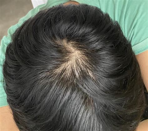 How Normal Is Hair Thinning? 