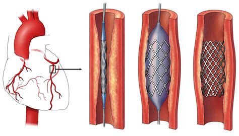 How Serious Is Having a Stent Put In - calories, carbs, nutrition