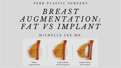 How much fat is in original breast - calories, carbs, nutrition