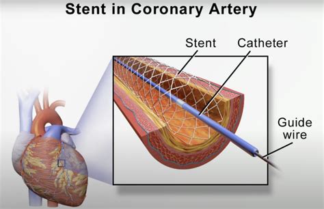 The Truth About Heart Stents