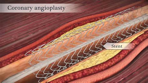 What Are the Side Effects of Heart Stents - calories, carbs, nutrition