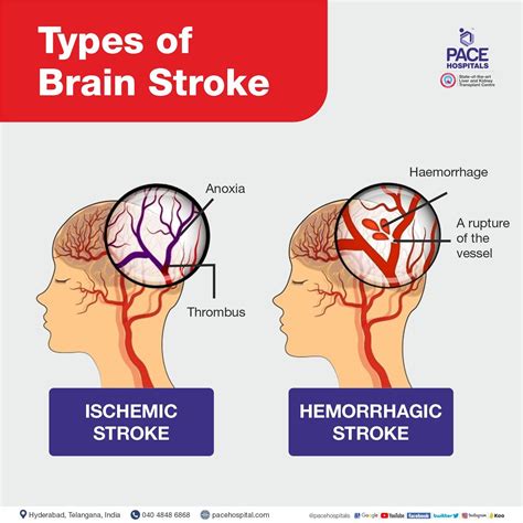 What Causes a Stroke - calories, carbs, nutrition