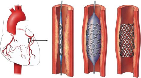 What Is a Heart Stent - calories, carbs, nutrition